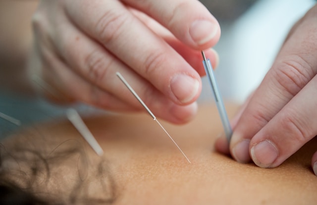 The roots of Acupuncture and Needles
