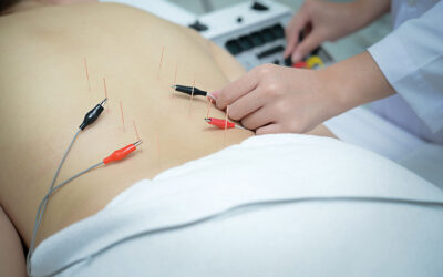 Electroacupuncture: A Modern Twist on Ancient Healing